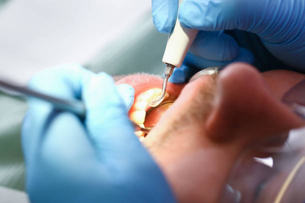 Best Emergency Treatment for Dental Infections or Abscesses in Burgaw, NC